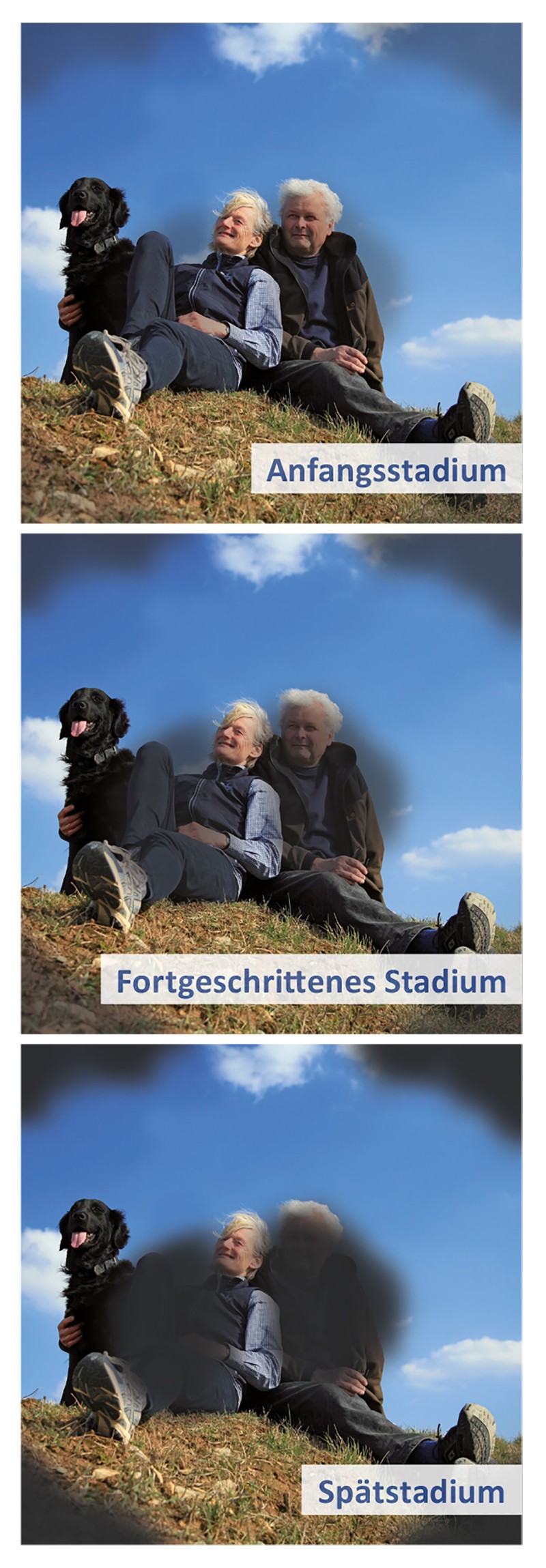 Stadien einer Retinopathie, Foto: einstein - Fotolia.com