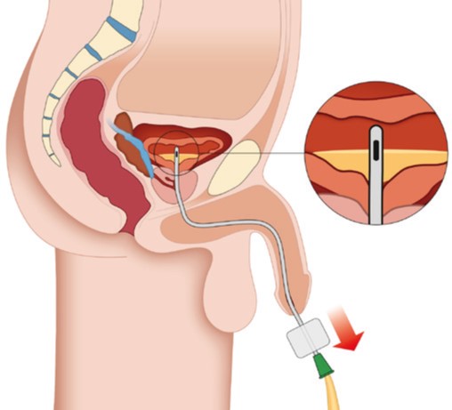 Das Bild zeigt, dass der Katheter Stück für Stück aus der Harnröhre herausgezogen wird, bis kein Urin mehr nachkommt.